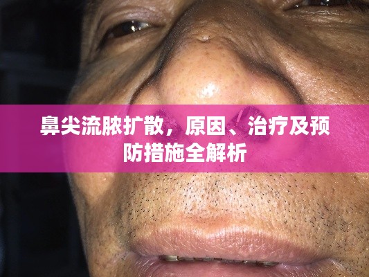 鼻尖流膿擴(kuò)散，原因、治療及預(yù)防措施全解析